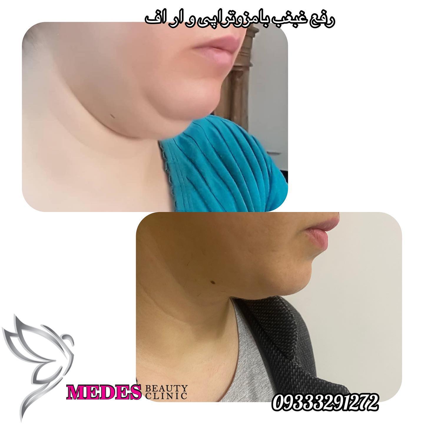 گالری مزوتراپی